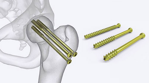 Hip Nailing in Iran: Affordable Fracture Repair