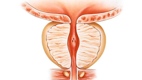 Prostatectomy Excellence with hamintour in Iran