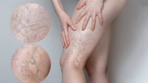 Eliminate Varicose Veins with Sclerotherapy in Iran