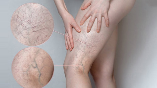 Eliminate Varicose Veins with Sclerotherapy in Iran
