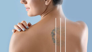 Erase Unwanted Ink with Tattoo Removal in Iran