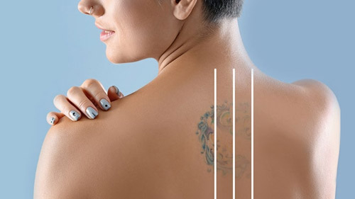 Erase Unwanted Ink with Tattoo Removal in Iran