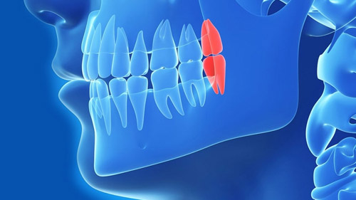 Pain-Free Wisdom Teeth Removal in Iran