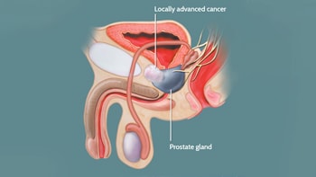 Prostate Cancer Treatment