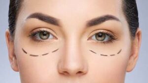 Puffy Eyelids Surgery in Iran