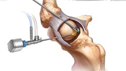Arthroscopic Knee Debridement in Iran: Affordable Knee Pain Relief