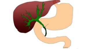 Comprehensive Guide to Bile Duct Surgery in Iran: Restoring Digestive Health with Precision