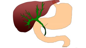 Comprehensive Guide to Bile Duct Surgery in Iran: Restoring Digestive Health with Precision
