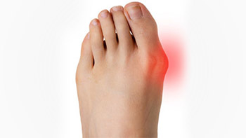 Bunion Surgery in Iran: Affordable Hallux Valgus Correction