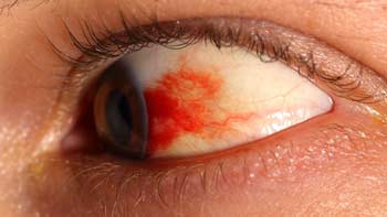 Preserve Your Vision with Diabetic Retinopathy Treatment in Iran