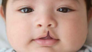 Why Choose Iran for Cleft Lip and Palate Repair?