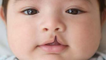 Why Choose Iran for Cleft Lip and Palate Repair?