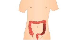 Comprehensive Guide to Colon Surgery in Iran