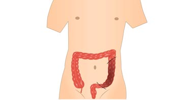 Comprehensive Guide to Colon Surgery in Iran
