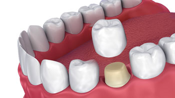 Restore Your Smile with Dental Bridges in Iran