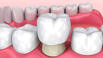 Revitalize Your Smile with Dental Crowns in Iran