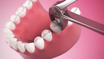 Relieve Dental Pain with Tooth Extraction in Iran