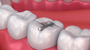 Preserve Your Smile with Dental Fillings in Iran