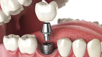 Affordable Dental Implants in Iran: Your Ultimate Guide