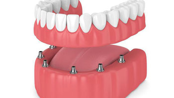 Rediscover Your Smile with Dentures in Iran