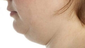 Why Choose Iran for Double Chin Surgery?