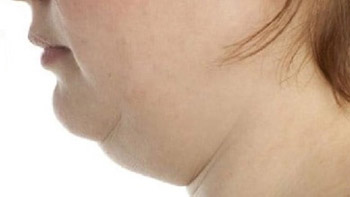 Why Choose Iran for Double Chin Surgery?