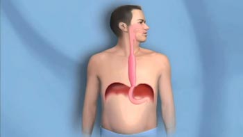 Ultimate Guide to Esophagus Surgery in Iran: Restoring Function with Precision