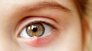 Effective Chalazion Treatment in Iran