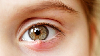 Effective Chalazion Treatment in Iran