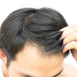 Understanding Hair Loss: Causes and Effective Treatments