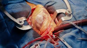 Iran's Premier Cardiovascular Surgery: Advanced Heart Care at Affordable Prices