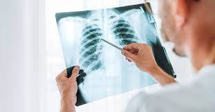 Iran’s Expertise in Chest Surgery: A Global Hub for Quality Care