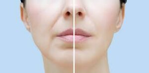 Nasolabial Fold Fillers in Iran: Affordable Facial Rejuvenation