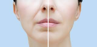 Nasolabial Fold Fillers in Iran: Affordable Facial Rejuvenation