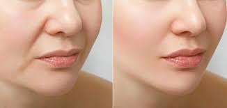 Marionette Line Fillers in Iran: Affordable Facial Renewal