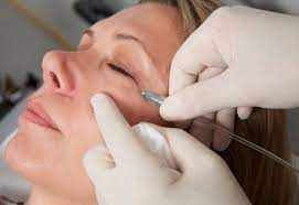 Boost Circulation with Carboxytherapy in Iran
