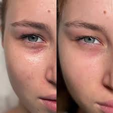 Brighten Eyes: Under-Eye Mesotherapy in Iran