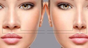 Best Rhinoplasty in tehran