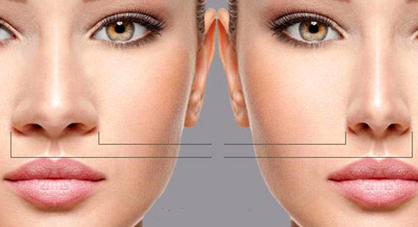 Best Rhinoplasty in tehran