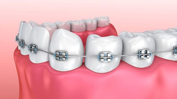 Perfect Your Smile with Dental Braces in Iran