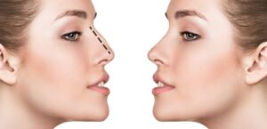 Premier Rhinoplasty Surgeons in Shiraz, Iran: Elegance in Every Contour