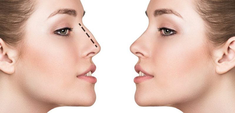 Premier Rhinoplasty Surgeons in Shiraz, Iran: Elegance in Every Contour