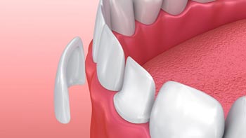 Transform Your Smile with Dental Veneers in Iran