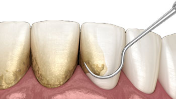 Restore Your Smile with Dental Scaling and Root Planing in Iran
