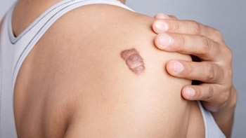 Why Choose Iran for Scar Revision Surgery?
