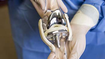 Hip Replacement in Iran: Expert Care at Unbeatable Prices