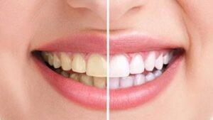 Achieve a Brilliant Smile with Teeth Whitening in Iran