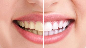 Achieve a Brilliant Smile with Teeth Whitening in Iran