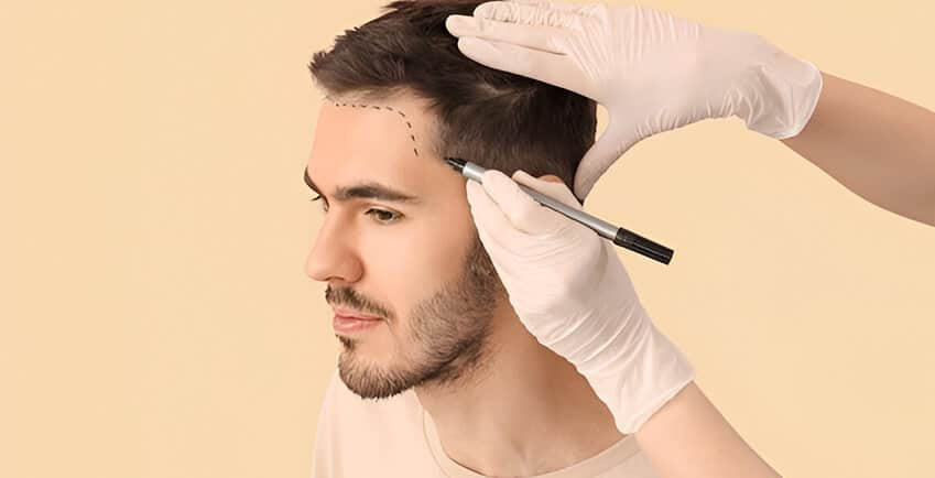 زراعة الشعر في مشهد