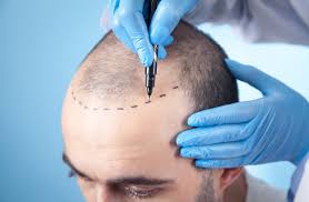 زراعة الشعر في طهران + أفضل العيادات